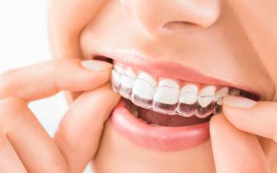 How Do You Live with Invisalign