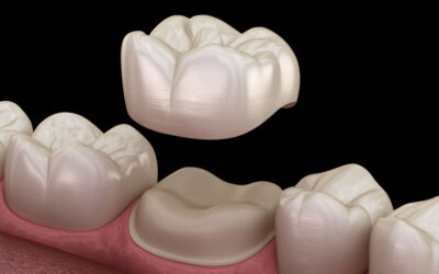 Dental Crowns vs. Other Restorative Options: Making the Right Choice